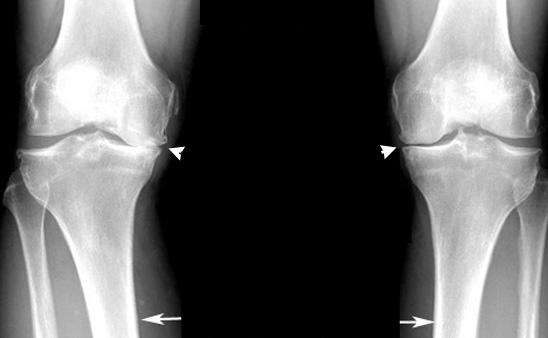 Resolve your knee pain by addressing its alignment MSK Neurology
