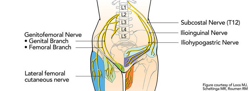 How to identify and treat lumbar plexus compression syndrome (LPCS