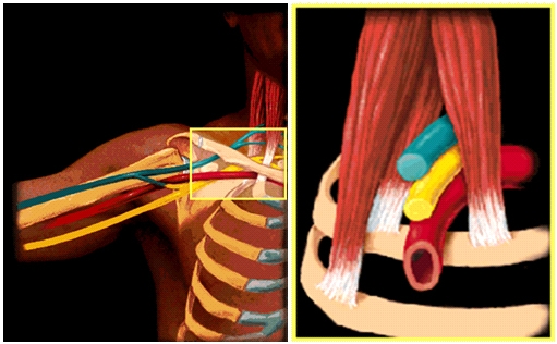 Thoracic Outlet Compression Syndrome and Its Surgical Treatment Modalities