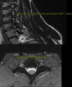 Kjetil Larsen on LinkedIn: Costoclavicular syndrome is a common but  misunderstood clinical problem…