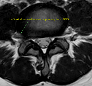 Kjetil Larsen on LinkedIn: Costoclavicular syndrome is a common but  misunderstood clinical problem…